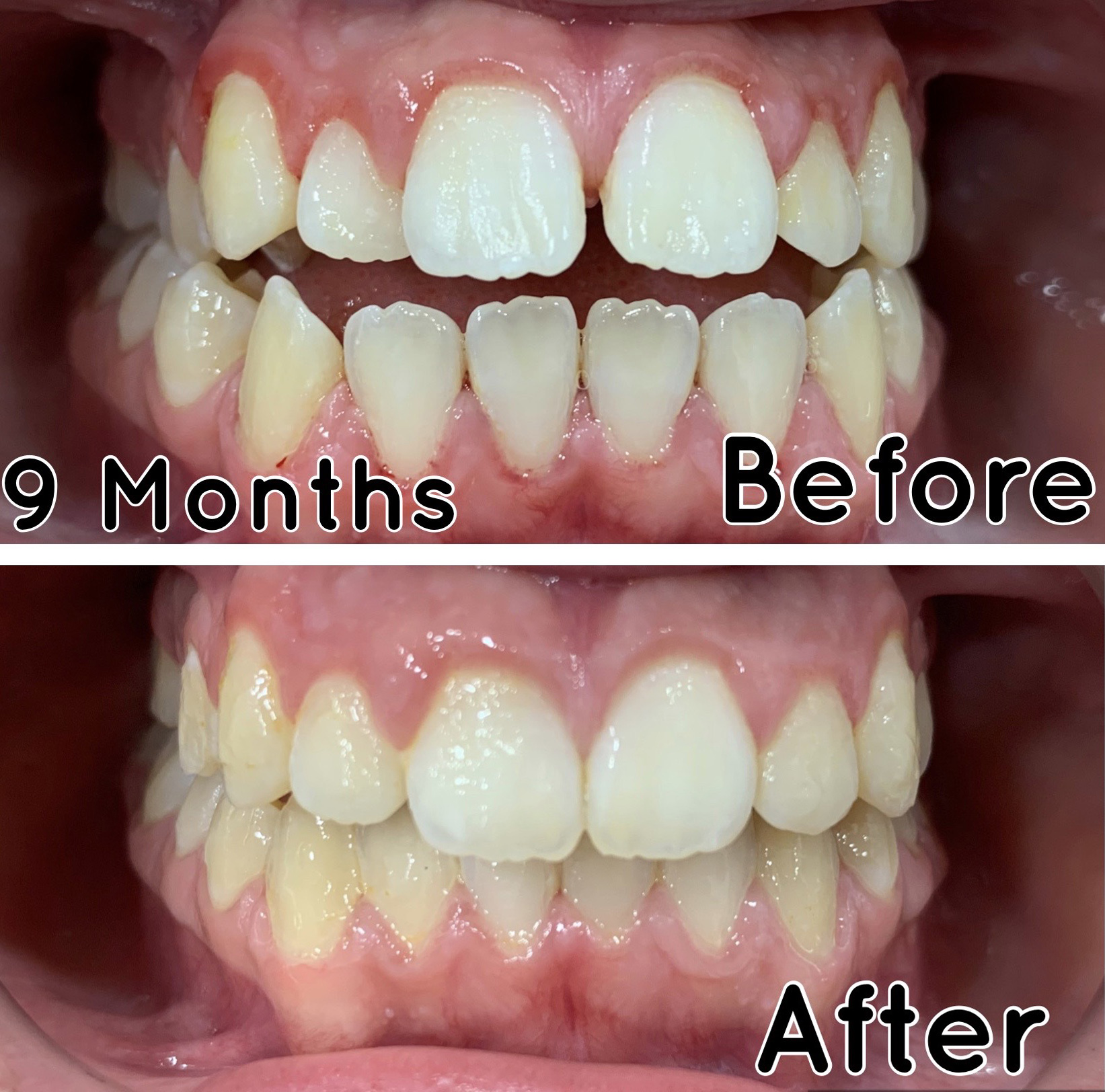 Invisalign® - 1 Smile Dental